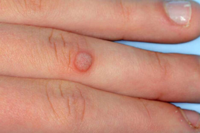 Siğiller için 10 doğal çözüm