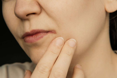 Uçukları hızlı bir şekilde tedavi etmek için 8 yöntem