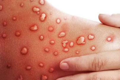 İstanbul'da maymun çiçeği alarmı!