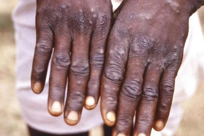 Maymun çiçeği virüsü, farelerden insanlara nasıl geçiyor