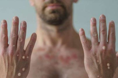 Maymun Çiçeği virüsünün tedavisi var mı?