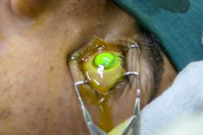 Yeni bir umut! Körlük tedavi edilebilir mi?