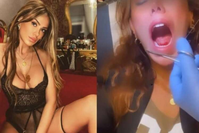 Öpüşürken kopan dilini diktirdi