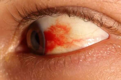 Tek gözünüz kanlanıyorsa dikkat!