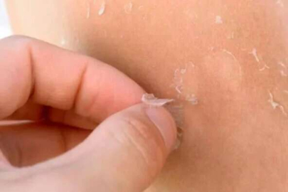 Cilt soyulmasının sebepleri nelerdir?