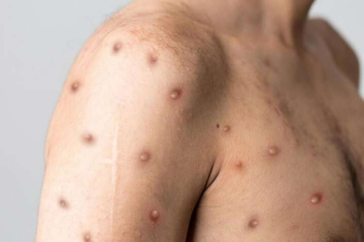 Pekin'de maymun çiçeği virüsü sebebiyle 2 kişi karantinaya alındı