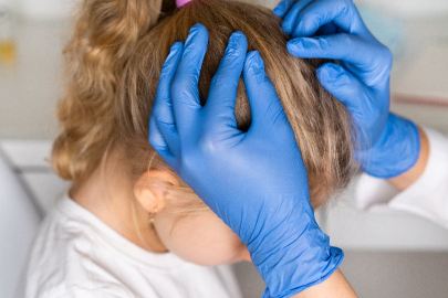 Saçta bit oluşumu, belirtileri ve tedavi yöntemleri