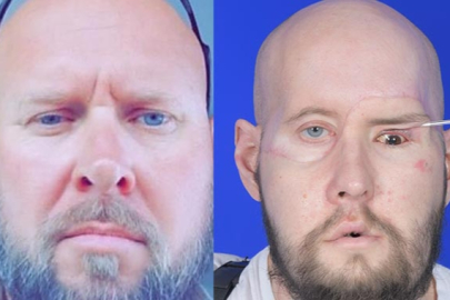 Dünyada bir ilk: Tam göz ve kısmi yüz nakli yapıldı