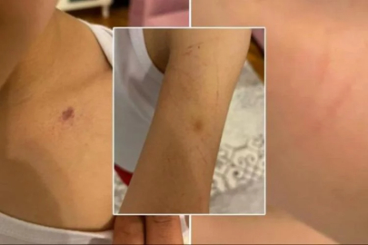 Anaokulunda öğretmenden dayak rezaleti! Çocuğunda morluklar görünce şoke oldu