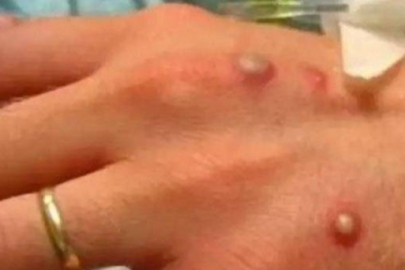 İlk ölüm kayıtlara geçti! Maymun çiçeği virüsü nasıl bulaşıyor, belirtileri neler?