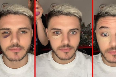 Wanda Nara, Mauro Icardi'nin gözündeki morluğu 3 dakikada yok etti