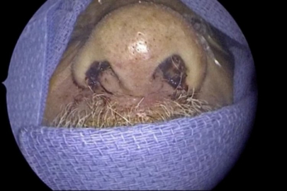 Burnundan 150 canlı kurtçuk çıktı