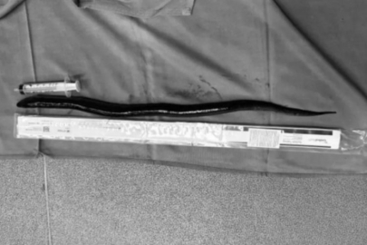 Vücudundan ameliyatla canlı yılan balığı çıkarıldı