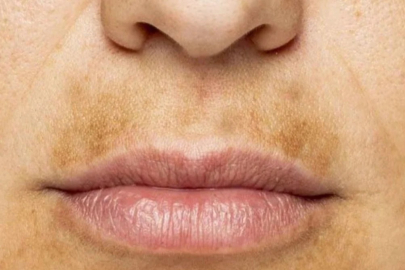 Uyurken dudak üstüne sürün, kararma ve lekeleri götürün...