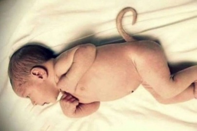 Kuyrukla doğan bebek tıp dünyasını şaşkına uğrattı!