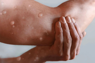 Maymun çiçeği virüsü öldürür mü?