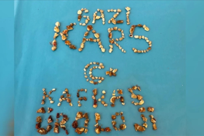 Kars'ta Hastanın İki Böbreğinden 300'ün Üzerinde Taş Çıktı