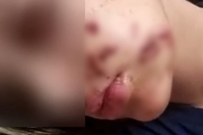 Yüzüne maytap isabet eden genç kız yaralandı