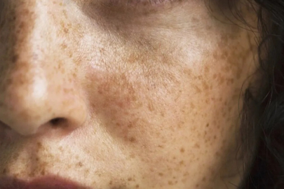 Güneş lekelerine İbn-i Sina yöntemi: Silgi gibi siliyor...