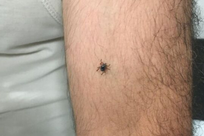 Kayseri’nin bir ilçesinde daha kene vakası