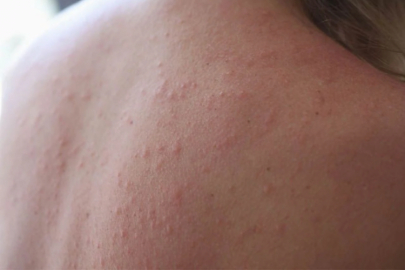 Pişikten nasıl kurtuluruz? Uzmanına sorduk...