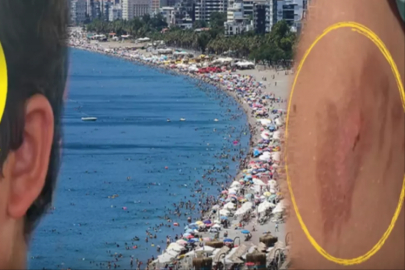 Vatandaşlar tedirgin! Denize giren yanıklarla çıkıyor