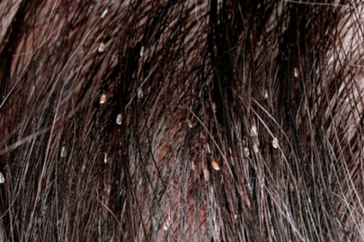 Yaz aylarında saç bitine dikkat!