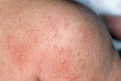 Sıcaklar Çocuklarda İsilik Alarmı Veriyor