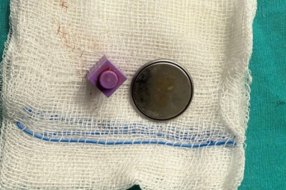 Disk pil ve lego parçası yutan bebek ameliyatla hayata döndü