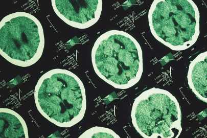 Araştırmaya göre, günde en az 3 bin adım atmak Alzheimer'ın ilerlemesini yavaşlatabilir