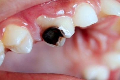 Ağız sağlığında devrim: Çürük dişi onaran jel geliştirildi