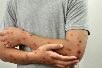 Acilen aşı yaptırılmalı, maymun çiçeği Türkiye'de var mı?