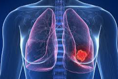 Kadınlarda akciğer kanseri görülme oranı artıyor