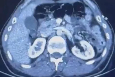 Ülkeye midelerinde uyuşturucu getiren şahıslar yakalandı