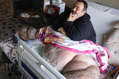 Kayseri'de fil hastası adam 300 kiloya ulaştı: 5 yıldır dışarı çıkamıyor
