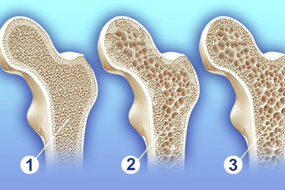 Sessiz Tehlike: Osteoporoz