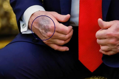 Trump'ın vücudunda bulunan morlukların nedeni belli oldu!