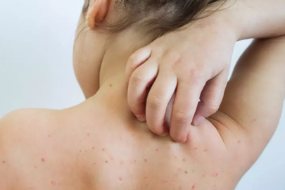 Uzmanından Suçiçeği Uyarısı