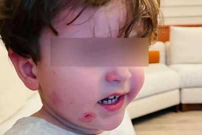 Bursa'daki kreş krizine açıklama geldi! "Darp değil, çocuklar arası anlaşmazlık"