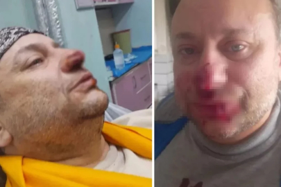 Onur Akay, başıboş pitbull köpeğinin saldırısında yaralandı