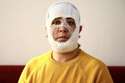 Adana'da cilt bakımı sonrası yüzünde yanık oluştu: İşletmeden şikayetçi oldu