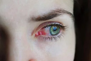 Baharın habercisi: Göz alerjisi belirtileri neler? Nasıl tedavi edilir?
