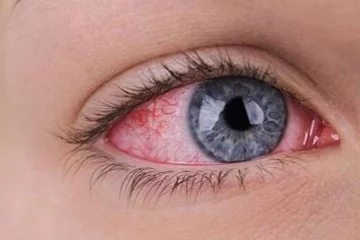Göz Tansiyonu Olarak Bilinen Glokom Çok Sinsi Bir Göz Hastalığıdır